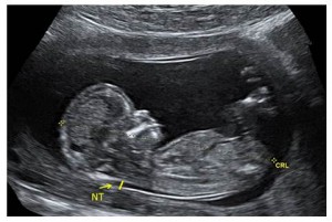 Nuchal translucency image